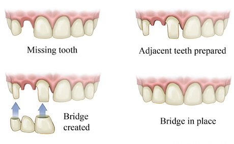 Dental Bridge