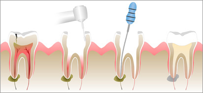 Root Canals