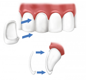 Veneers and Porcelain Veneers